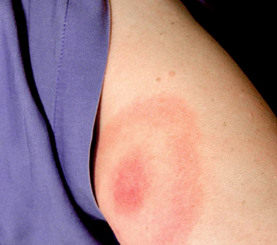 lyme lyme